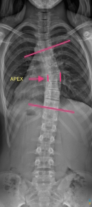 Scoliosis Vertebra Wedging