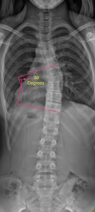 Cobb Angle Example | Scoliosis