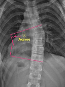 Cobb Angle Example | Scoliosis