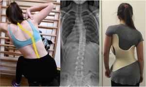 Scoliosis Bracing Complements Schroth – Gensingen Brace by Weiss (Chéneau-Gensingen)